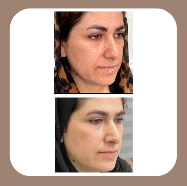 خرید کرم ضد لک لاکچری کوین ضد لک بسیار قوی وتناژ پوست را اصلاحح و پوست را روشن می کند_کاملا اصل تحت لیسانس فرانسه 50 میلی لاکچری کوین - فروشگاه زیبایی با بیتا